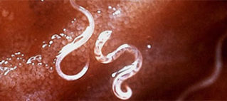 Three in five migrant workers have worms… Three in five migrant workers have worms…